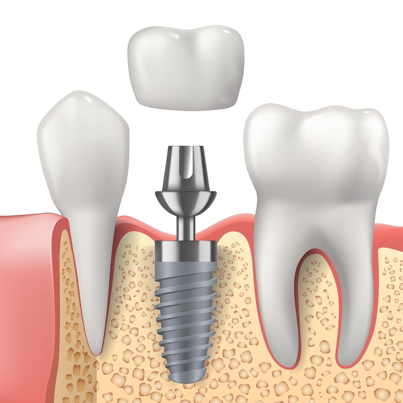 DENTAL IMPLANTS & TOOTH REMOVAL Meadowmont Dentistry
